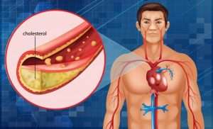 diagram showing cholesterol blocking artery human body 1308 43348 Isabgol / Isabgol ke Fayde in Hindi